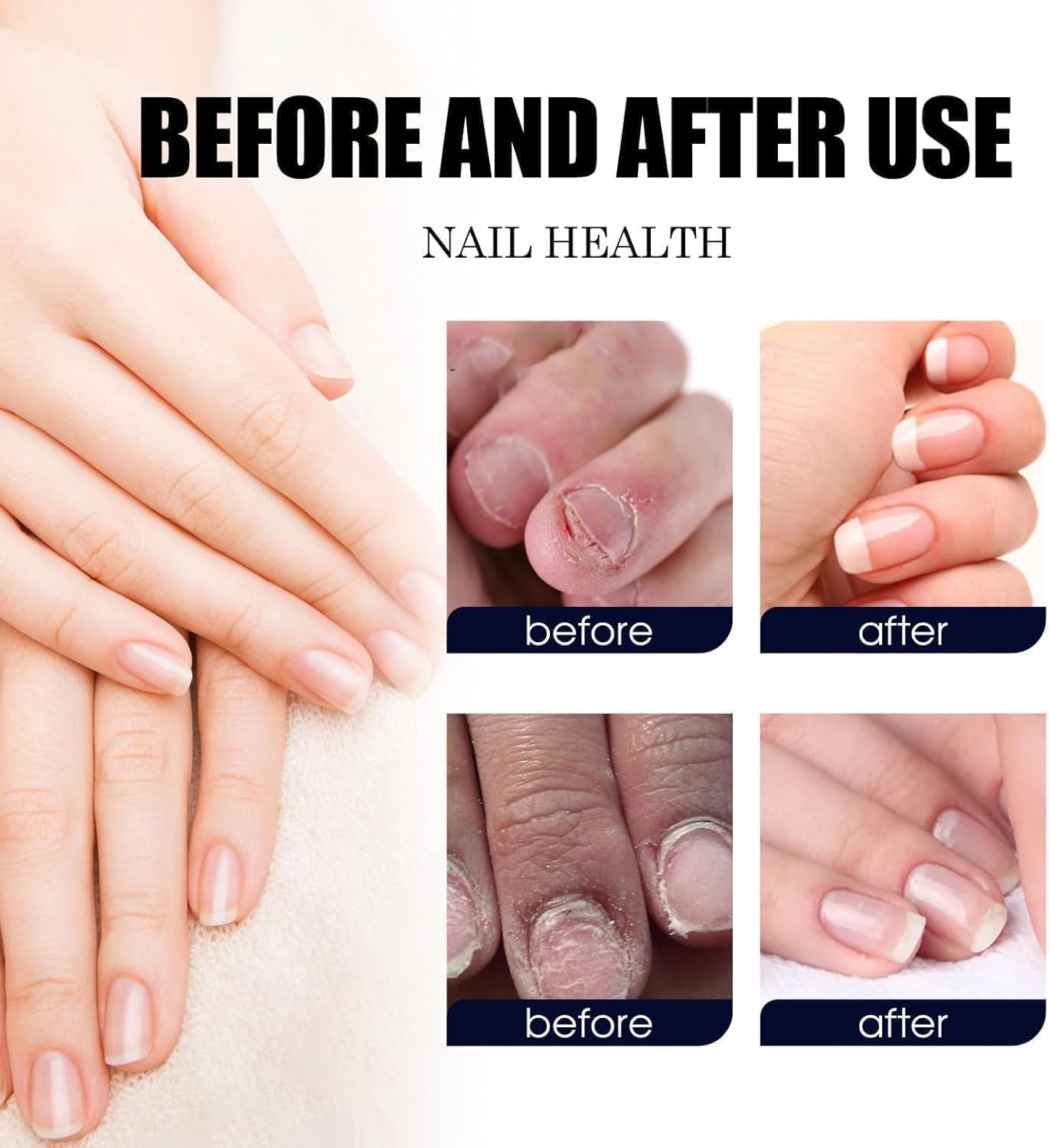 Ginger Nail Treatment Nail Support Nail Care